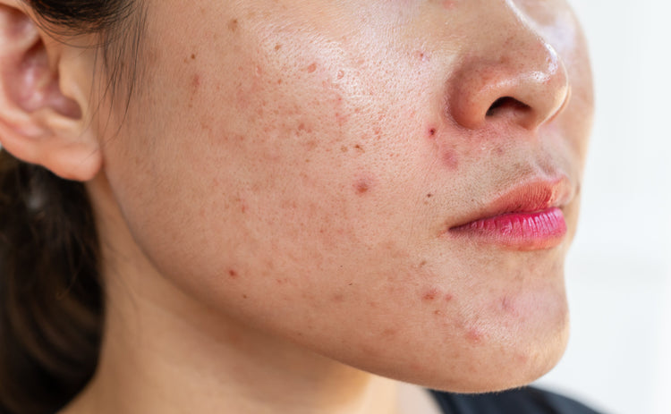 Acne