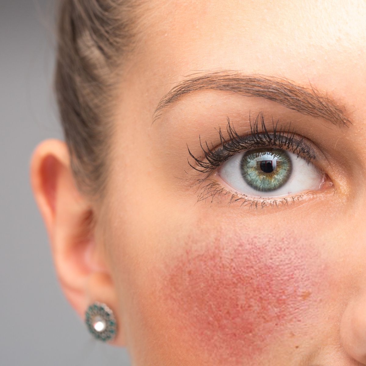 Rosacea & Sensitive Skin