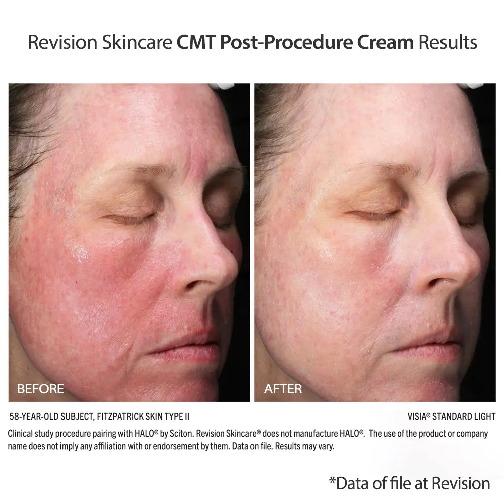 Revision Skincare CMT Post-Procedure Cream (0.5 oz)
