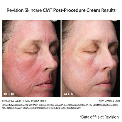 Revision Skincare CMT Post-Procedure Cream (0.5 oz)